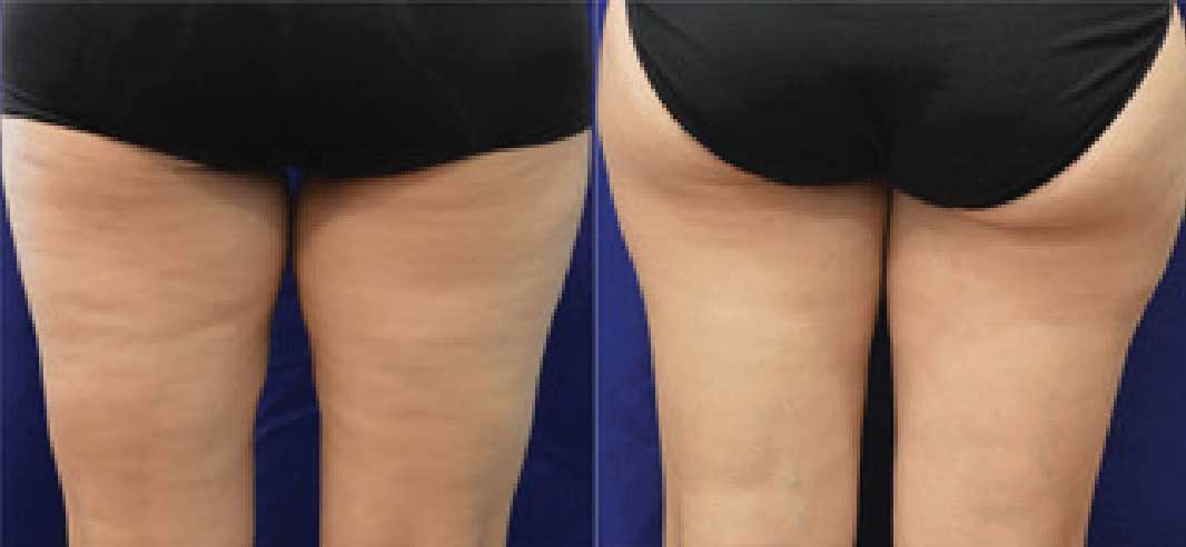 Before and after images of buttocks treated with Evolve by InMode.