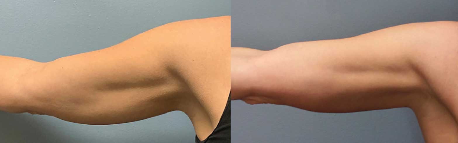 Before and after images of arms treated with Evolve by InMode.