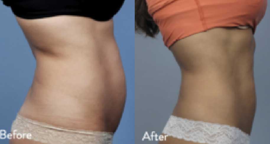  Before and after images of belly treated with Evolve by InMode.