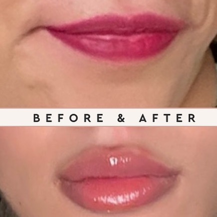 Woman’s pouty lips after lip flip treatment