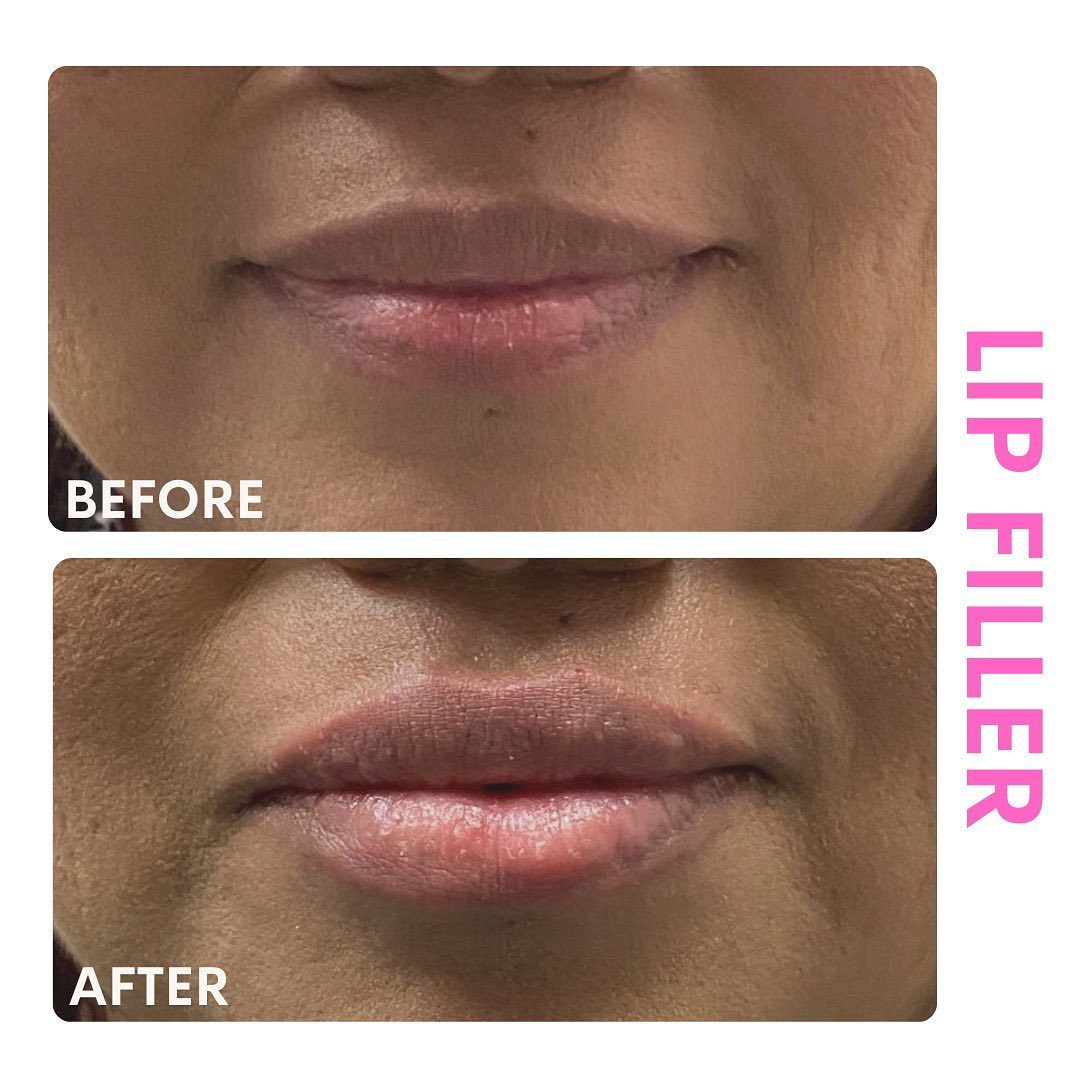 Before and After results of lip filler injection