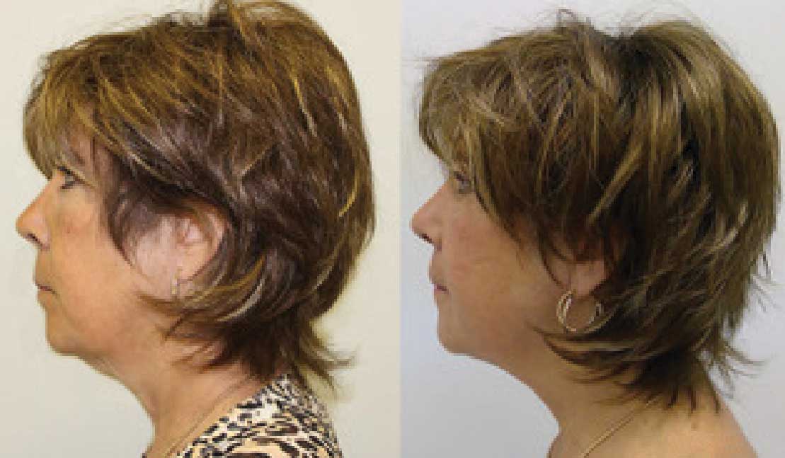 InMode Evoke face tightening before and after pictures of a woman
