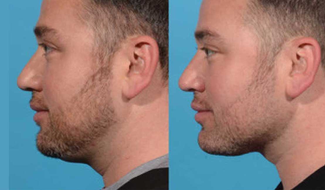 InMode Evoke face tightening before and after pictures of a man
