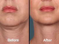 man's chin before and after