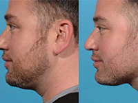man's chin before and after