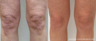 Morpheus8 Results on sagging knee skin