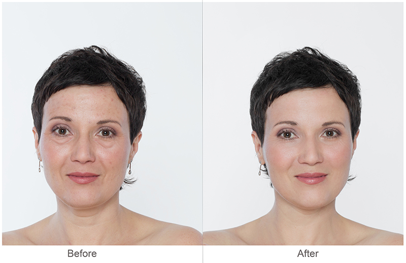 Juvederm Before and After